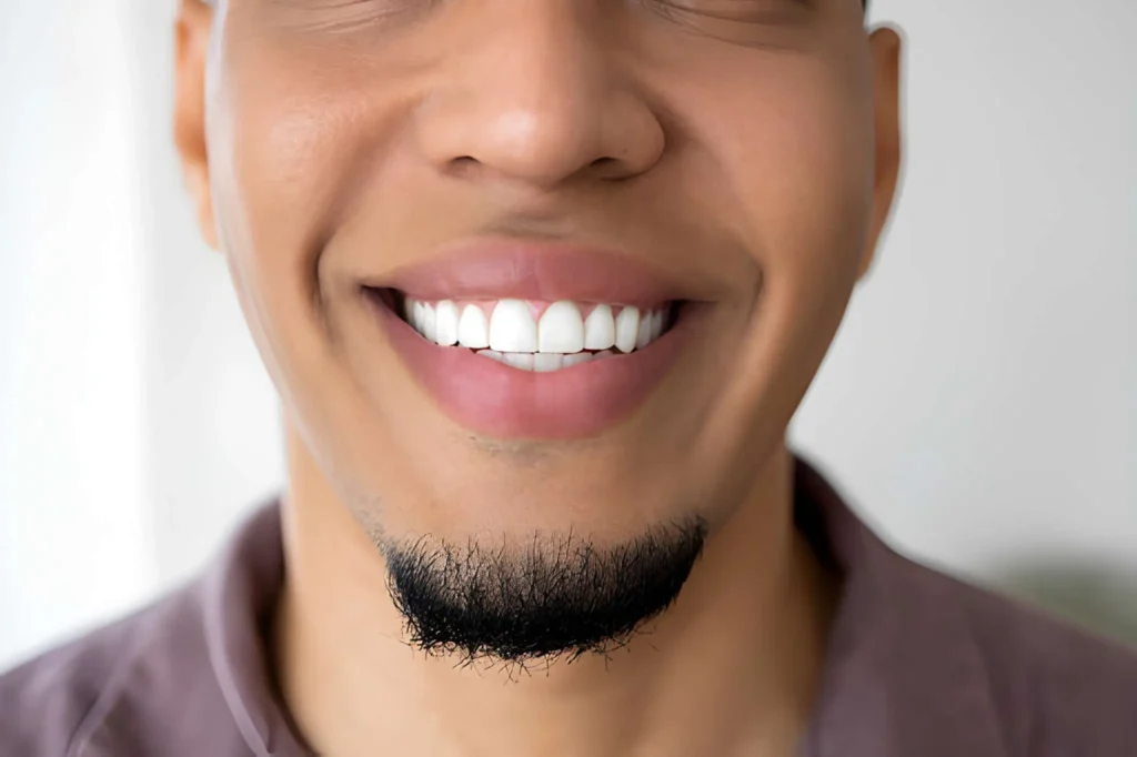 Full-Arch Smile Makeover What to Know About All-on-4 Implants