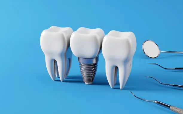 How Dental Implants in Indianapolis Work to Restore Lost Teeth?