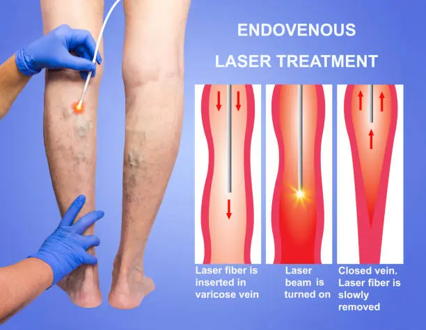 Why Endovenous Laser Treatment Is A Popular Choice For Varicose Vein Relief
